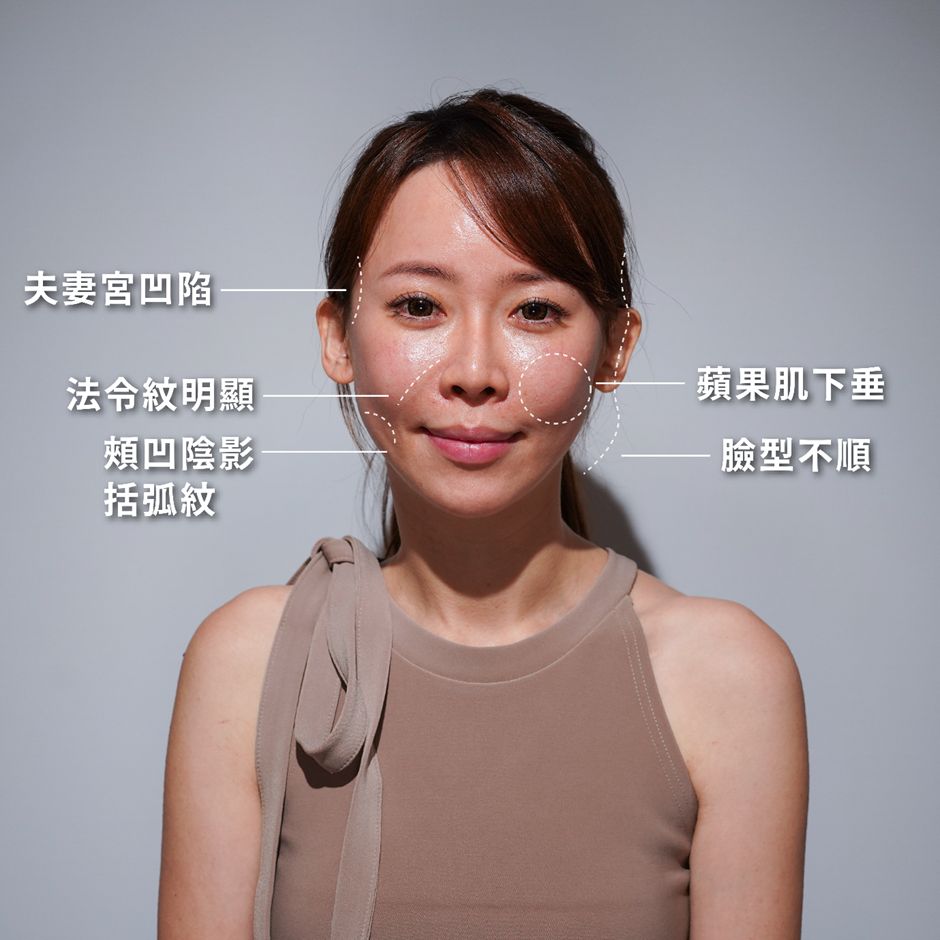 蘋果肌下垂、臉頰凹陷、法令紋變深，臉皮觸感也變鬆弛，湞媄鉌羚建議他使用索夫波治療