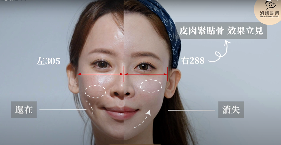 索夫波的BA效果，湞媄診所案例